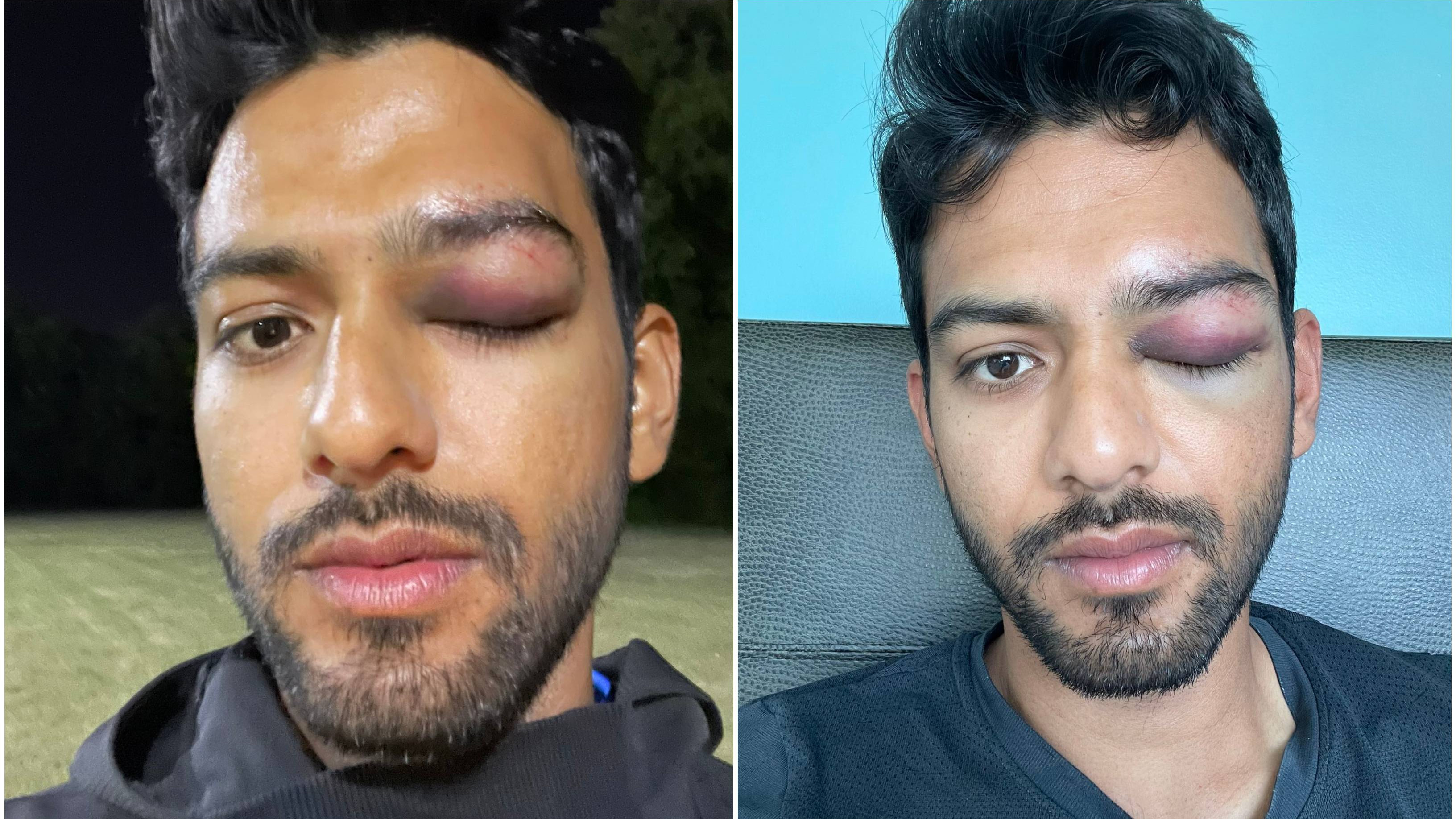 'Survived a possible disaster': Unmukt Chand suffers a horrifying eye injury, shares pictures on Twitter