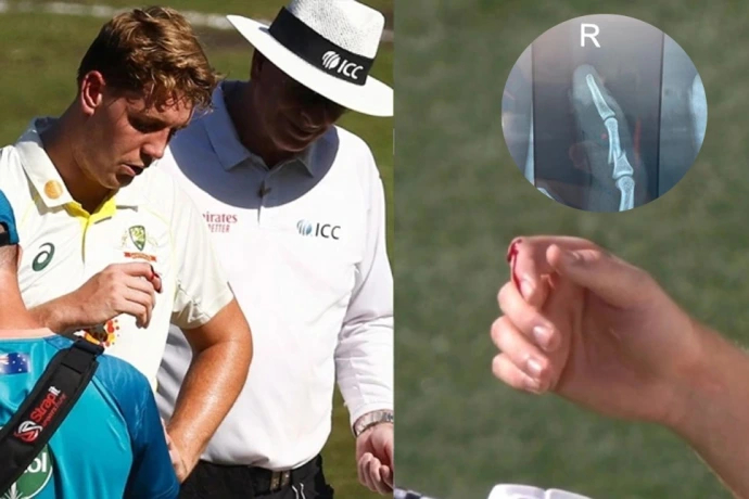 Green suffered a fractured finger during the second Test in Perth vs South Africa | Twitter